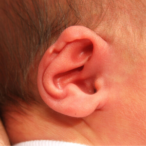 Helixrand afwijking oor