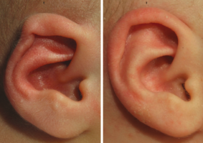 Helix deformities | Helical rim ear correction baby - EarWell.eu