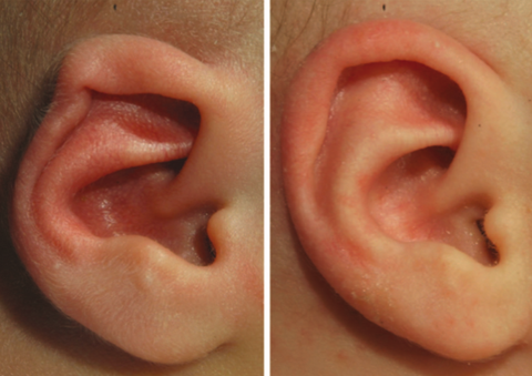 Helixrand oorafwijking