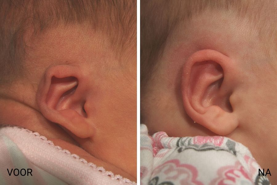 baby misvormde oren