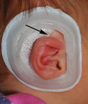 earwell behandeling stap 1