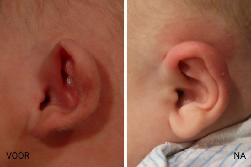 Protruding ears in babies stickyout ears correction EarWell.eu