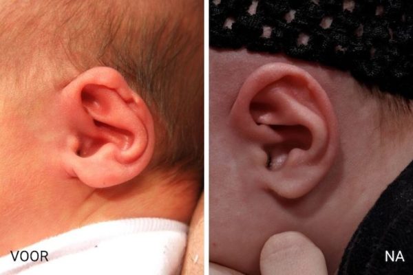 Helix deformities | Helical rim ear correction baby - EarWell.eu