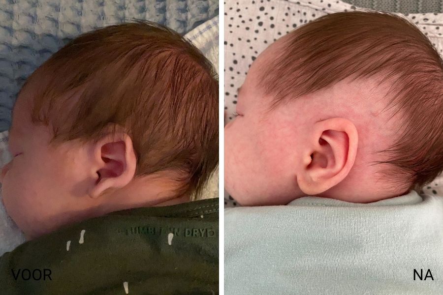 oorcorrectie flaporen baby